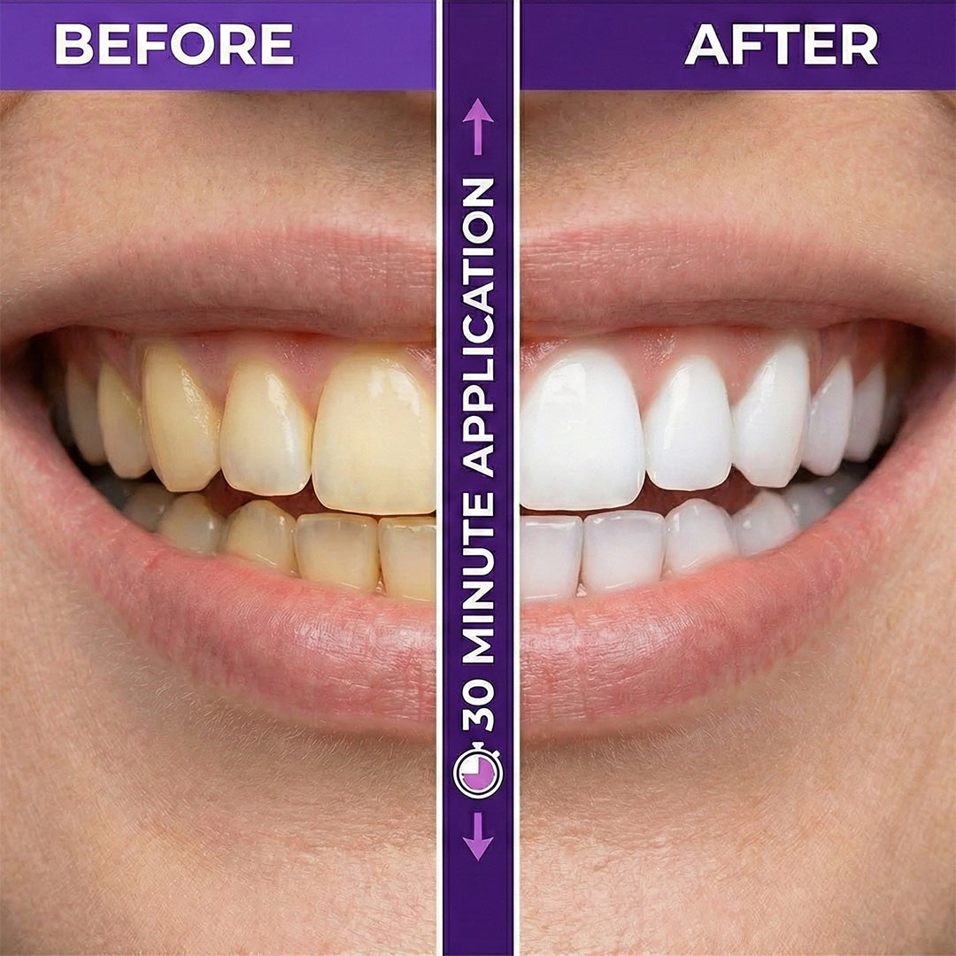 Purple Whitening Strips™