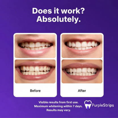 Purple Whitening Strips™